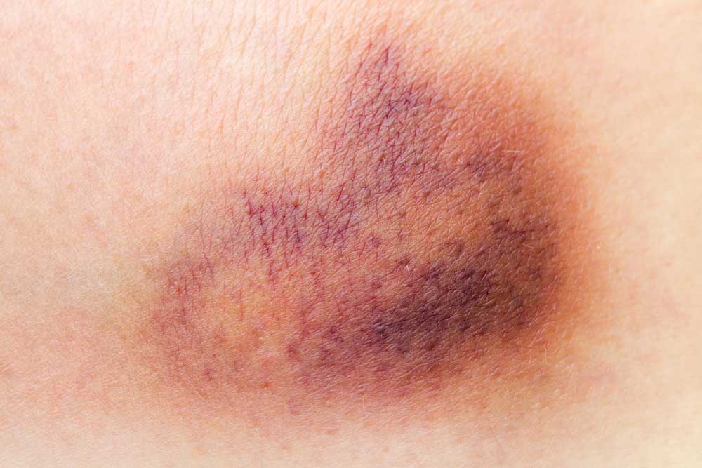 picture of Bruise